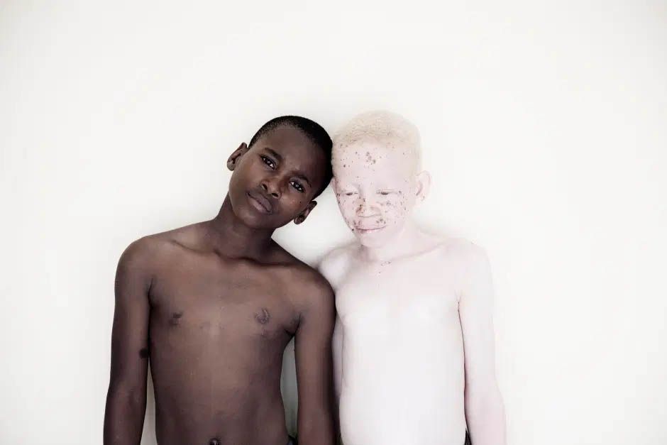 Проклятие белой кожи или почему в Танзании выслеживают и убивают детей-альбиносов